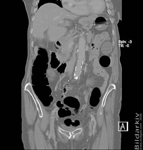 CT colon 24